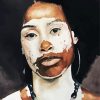 Asian Vitiligo Woman Art Diamond Painting