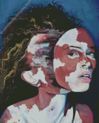 Vitiligo Girl Art Diamond Painting